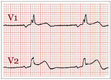 fig2. Electrocardiograma